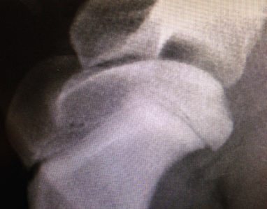 osteochondrosi-1